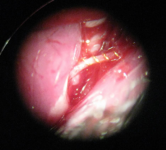 microcoil-BCAS 1